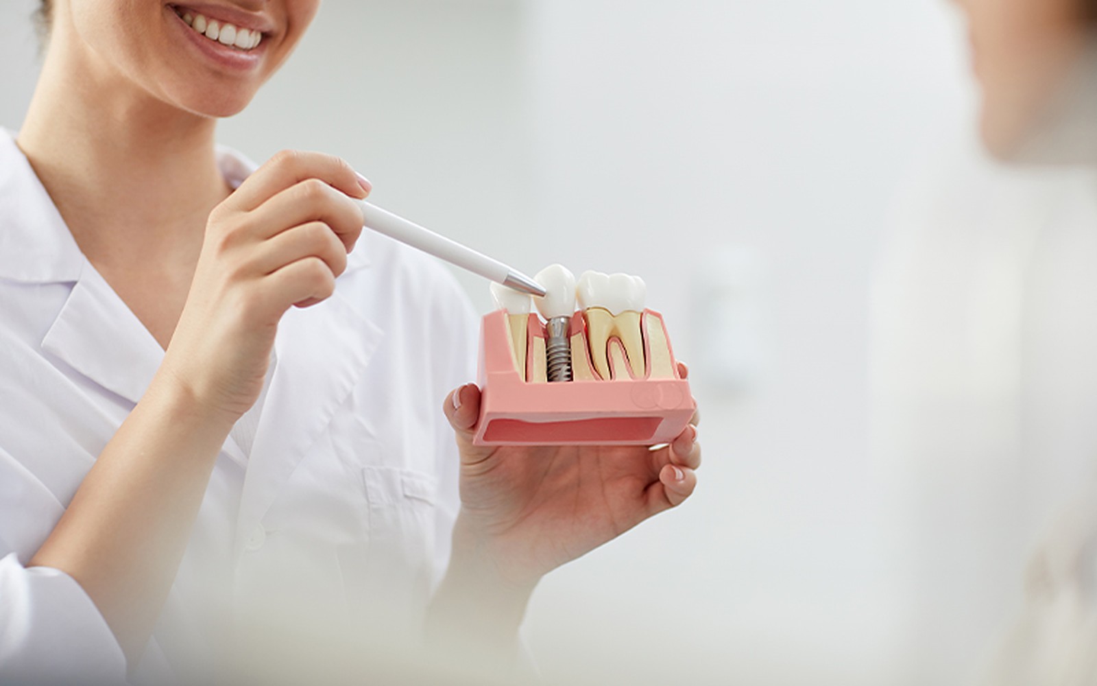 Implantes dentários